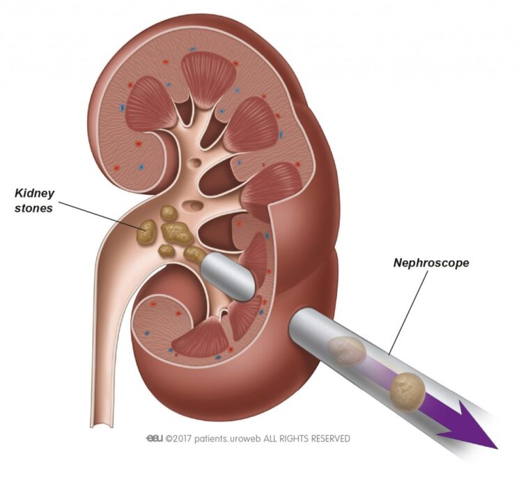 آموزش عمل جراحی PCNL