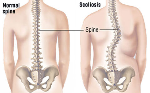 آموزش جراحی اسکولیوز