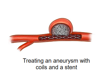 آموزش کویل گذاری در آنوریسم مغزی